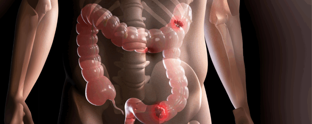 semi-transparent model of colorectal cancer